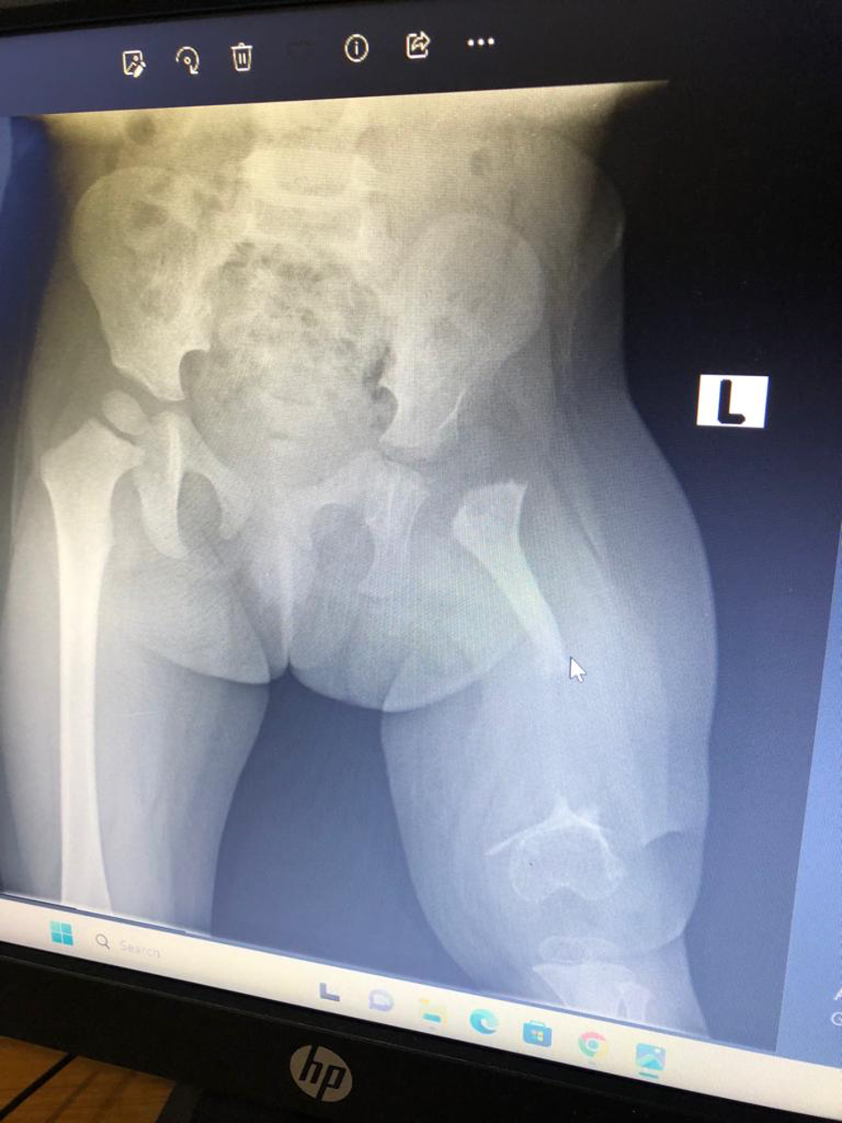 Ghana 2023 oosten femur